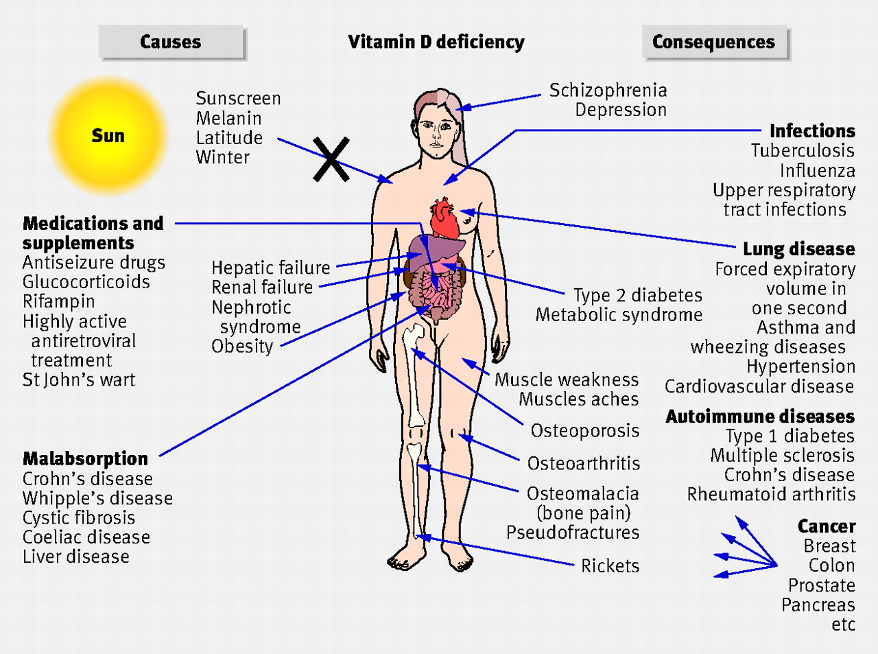 Vitamin D Deficiency A Cause Of Chronic Pain Hometown Family 